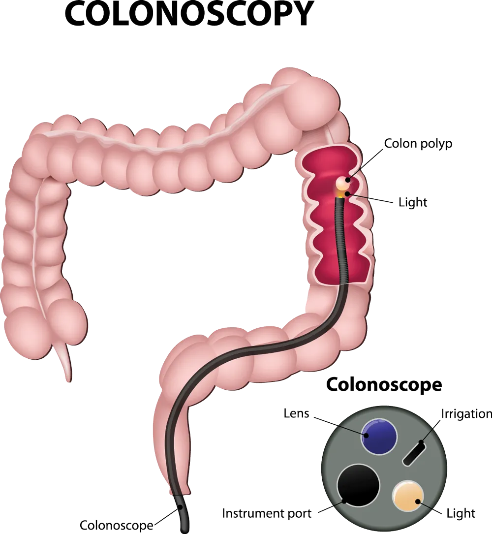 What happens during a colonoscopy?