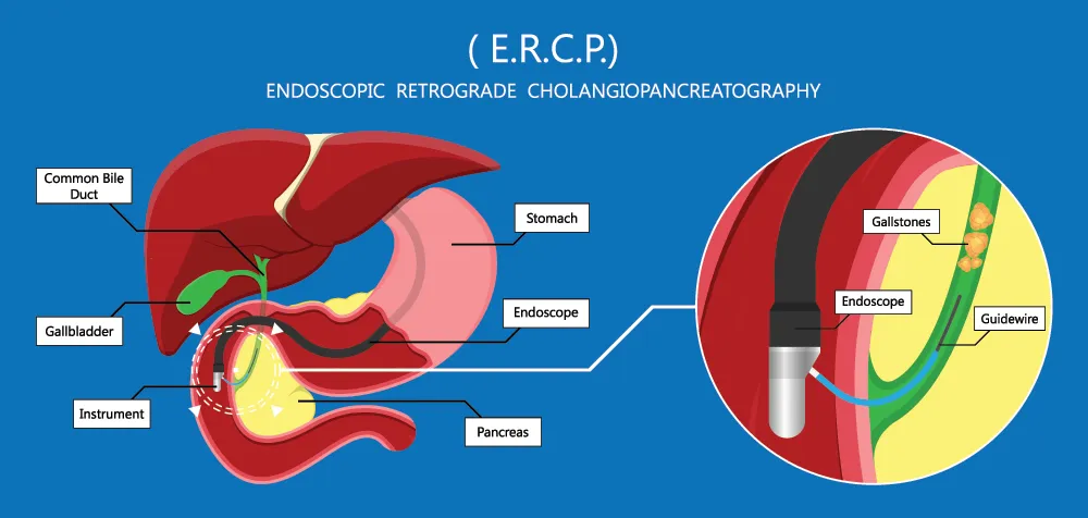ERCP procedure diagram