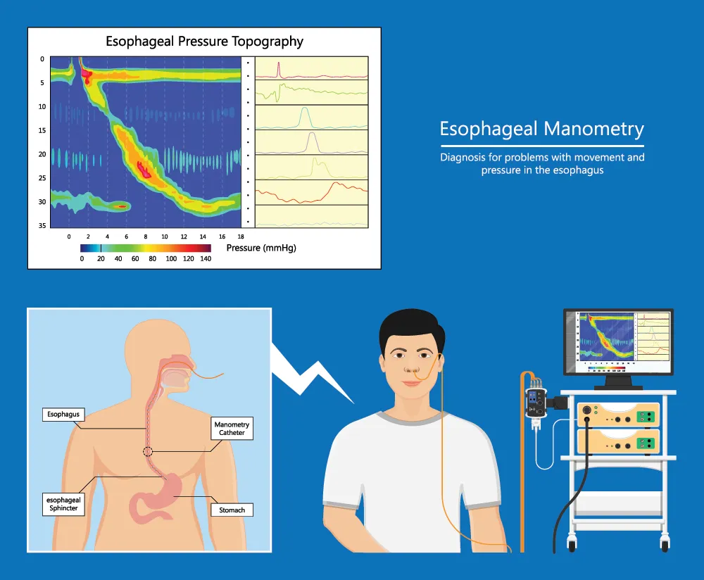 What happens during a ph/impedance and manometry?
