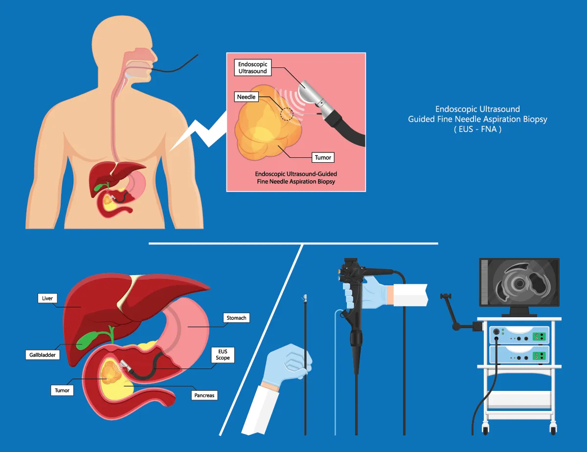 What happens during an eus?