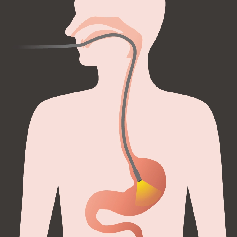 What happens during an upper endoscopy?